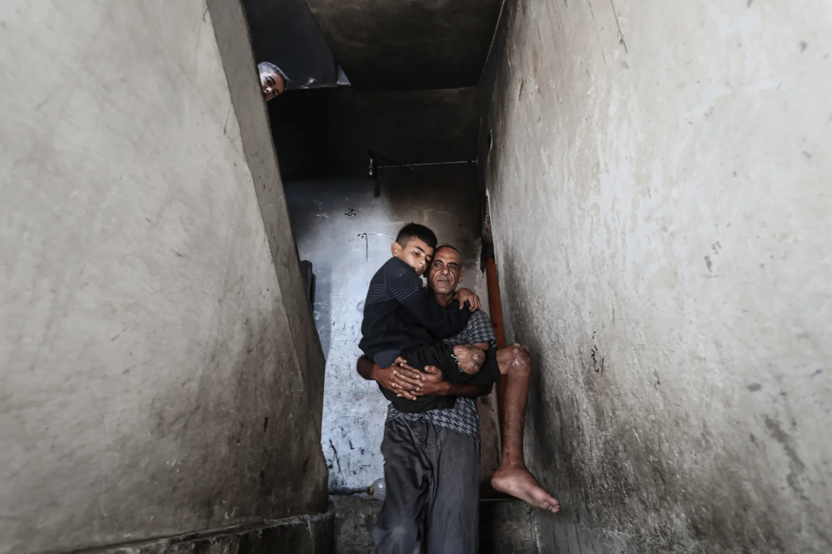 Gazze’de bir bacağını kaybeden Uda’nın diğer bacağı da risk altında