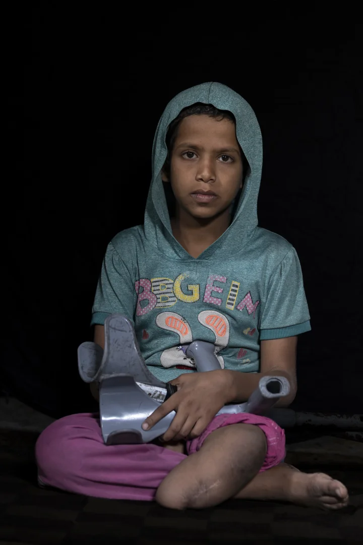 Gazzeli çocuklar, vücutlarında İsrail soykırımının izlerini taşıyor